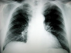 Phương pháp mới phát hiện bệnh ung thư phổi